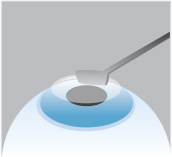 Preparing the corneal surface for PRK