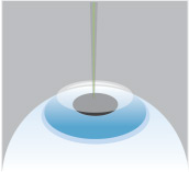 Excimer laser reshaping the cornea during PRK