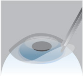 Protective bandage contact lens after PRK